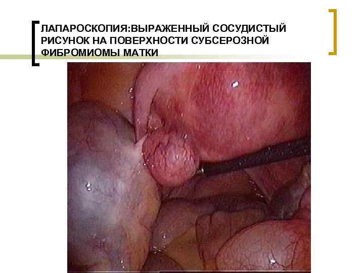 ЛАПАРОСКОПИЯ: ВЫРАЖЕННЫЙ СОСУДИСТЫЙ РИСУНОК НА ПОВЕРХНОСТИ СУБСЕРОЗНОЙ ФИБРОМИОМЫ МАТКИ 