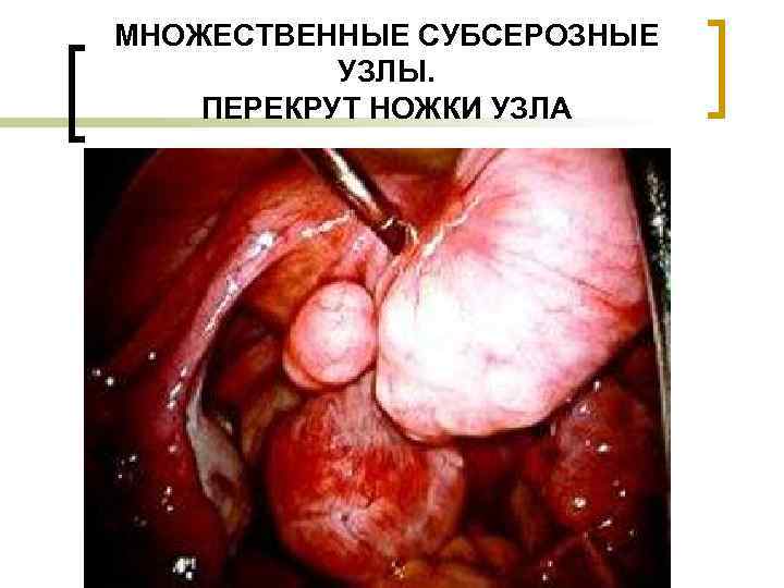 МНОЖЕСТВЕННЫЕ СУБСЕРОЗНЫЕ  УЗЛЫ. ПЕРЕКРУТ НОЖКИ УЗЛА 