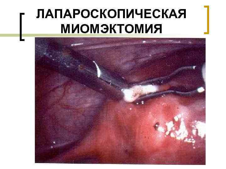 ЛАПАРОСКОПИЧЕСКАЯ  МИОМЭКТОМИЯ 