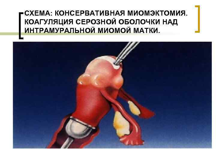 СХЕМА: КОНСЕРВАТИВНАЯ МИОМЭКТОМИЯ. КОАГУЛЯЦИЯ СЕРОЗНОЙ ОБОЛОЧКИ НАД ИНТРАМУРАЛЬНОЙ МИОМОЙ МАТКИ. 