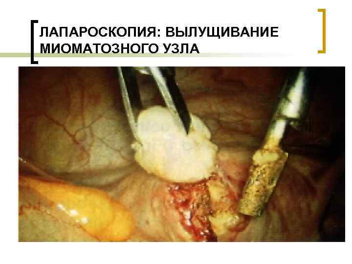 ЛАПАРОСКОПИЯ: ВЫЛУЩИВАНИЕ МИОМАТОЗНОГО УЗЛА 