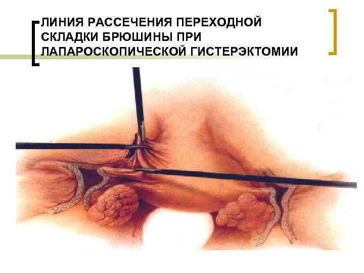 ЛИНИЯ РАССЕЧЕНИЯ ПЕРЕХОДНОЙ СКЛАДКИ БРЮШИНЫ ПРИ ЛАПАРОСКОПИЧЕСКОЙ ГИСТЕРЭКТОМИИ 