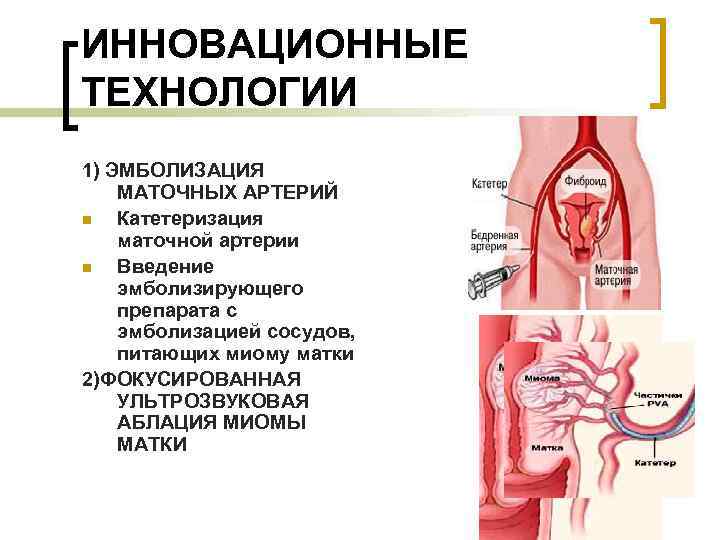 Эмболизация маточных артерий. Катетеризация маточных артерий.