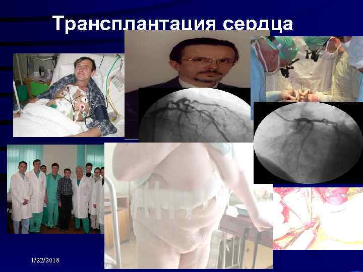  Трансплантация сердца 1/22/2018 