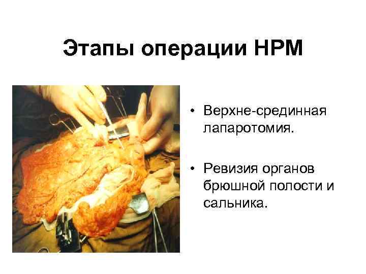   Этапы операции НРМ    • Верхне-срединная    лапаротомия.
