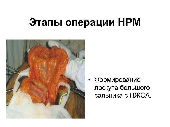   Этапы операции НРМ      • Формирование  