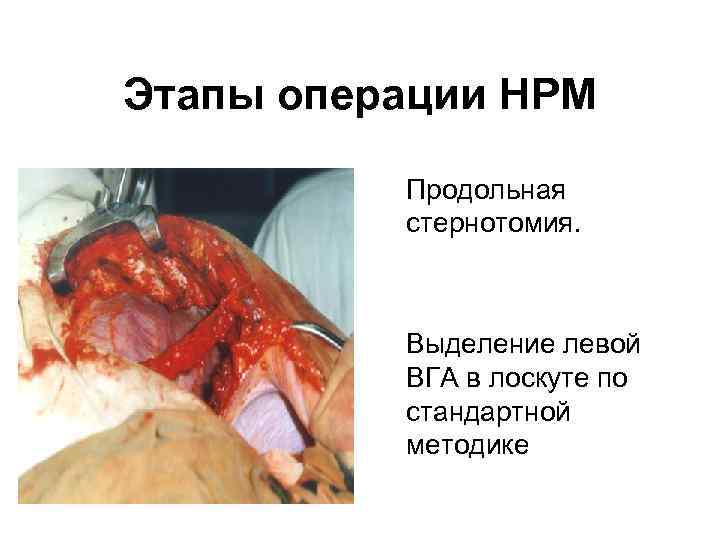   Этапы операции НРМ    • Продольная    стернотомия.