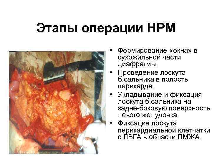   Этапы операции НРМ    • Формирование «окна» в  