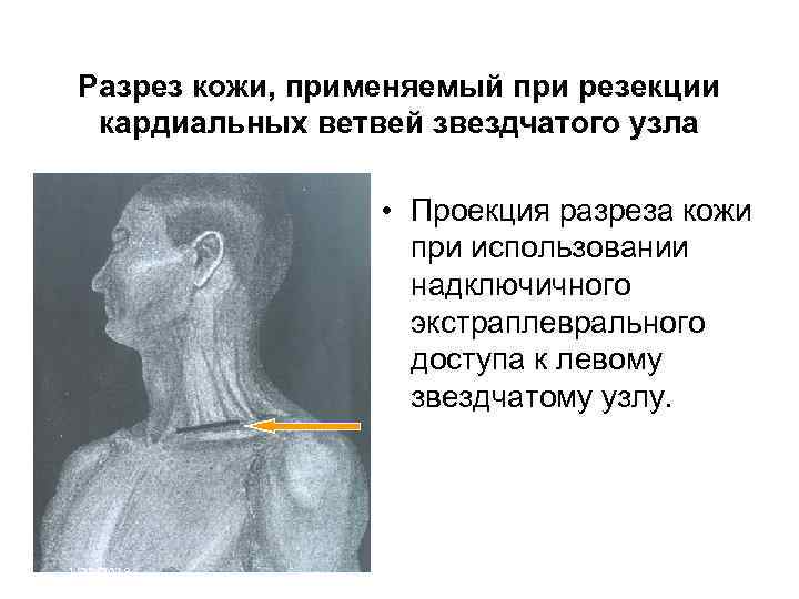  Разрез кожи, применяемый при резекции  кардиальных ветвей звездчатого узла   