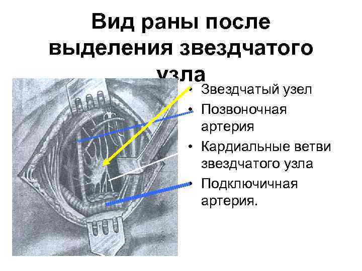   Вид раны после выделения звездчатого   узла   • Звездчатый