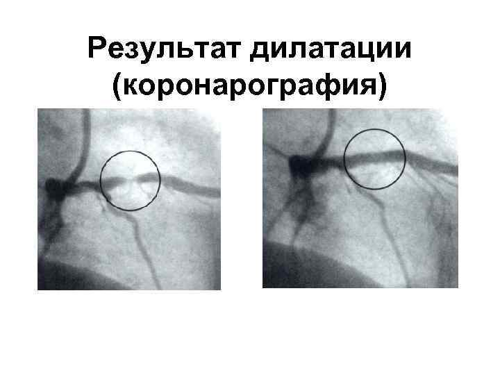   Результат дилатации   (коронарография) 1/22/2018 