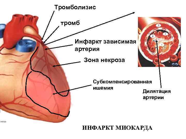   Тромболизис    Тромб в просвете    коронарной артерии