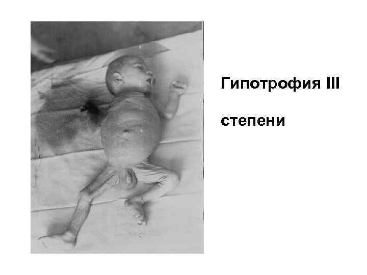 Гипотрофия III степени 