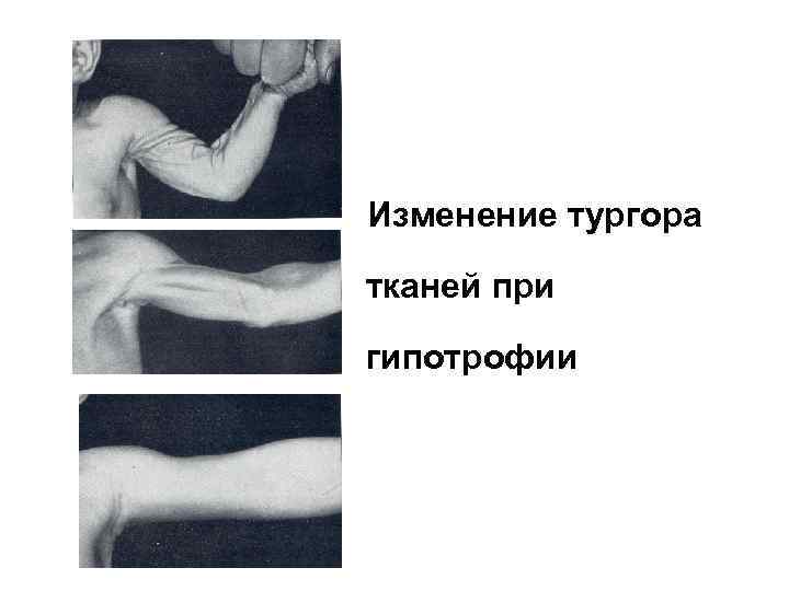 Изменение тургора тканей при гипотрофии 