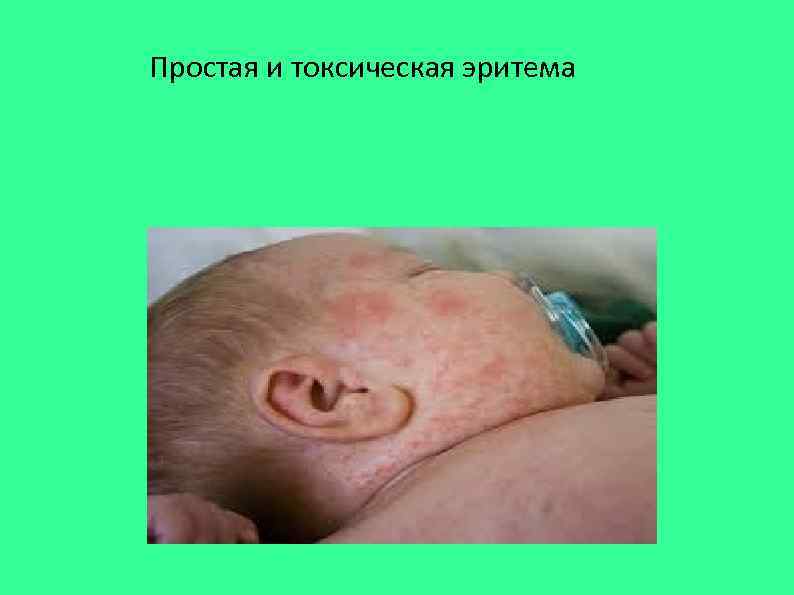 Простая и токсическая эритема 