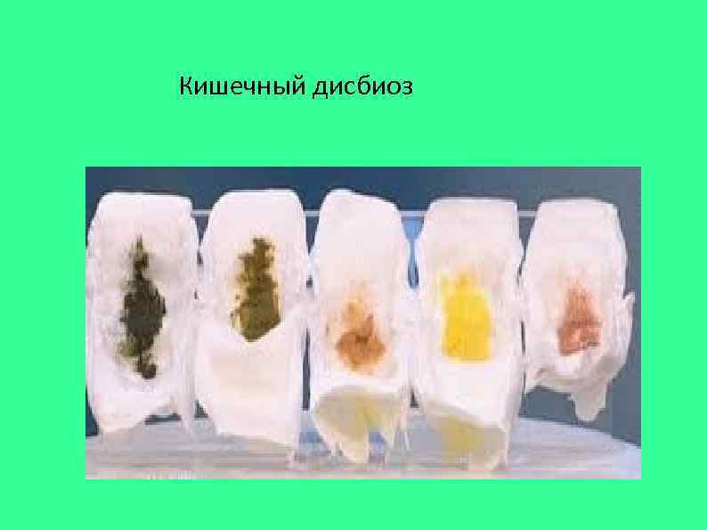Кишечный дисбиоз 