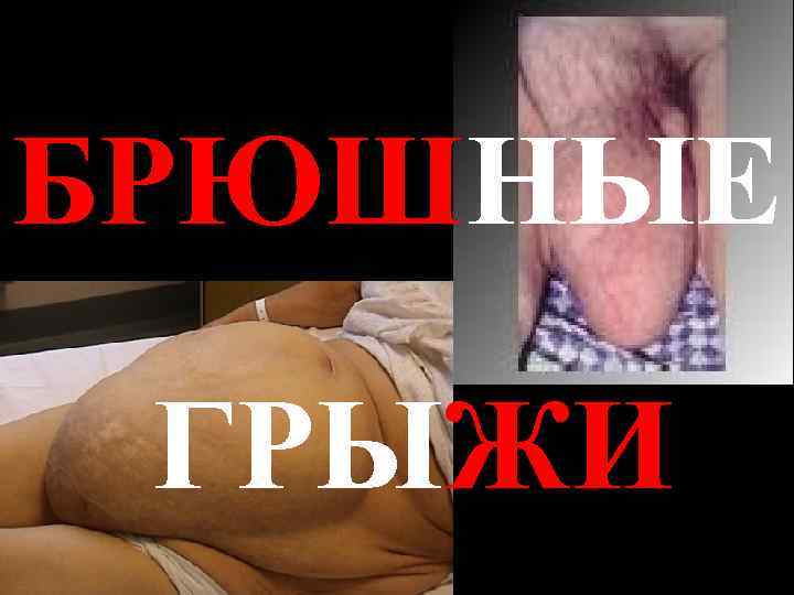 БРЮШНЫЕ  ГРЫЖИ 