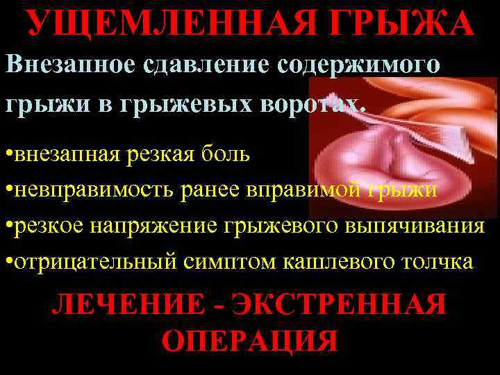  УЩЕМЛЕННАЯ ГРЫЖА Внезапное сдавление содержимого грыжи в грыжевых воротах.  • внезапная резкая