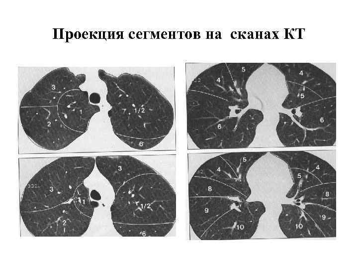 Проекция сегментов на сканах КТ 