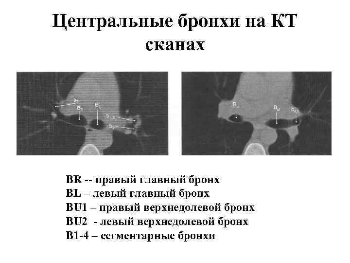 Бронхи на кт схема