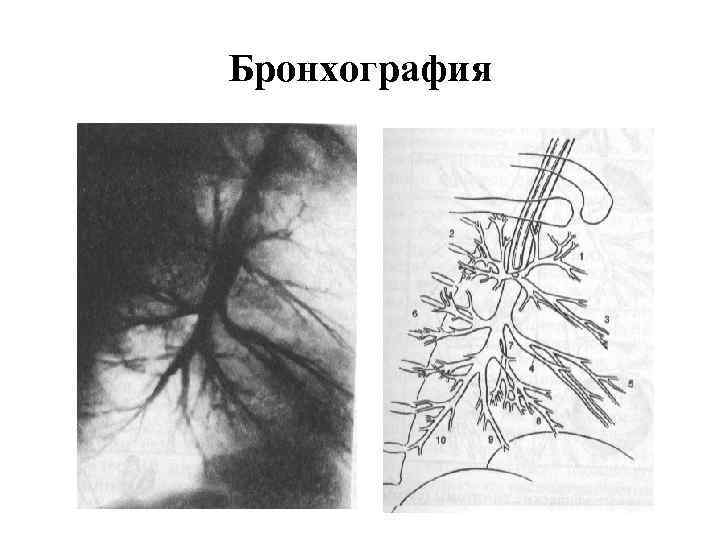 Бронхография 