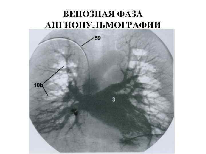   ВЕНОЗНАЯ ФАЗА  АНГИОПУЛЬМОГРАФИИ 