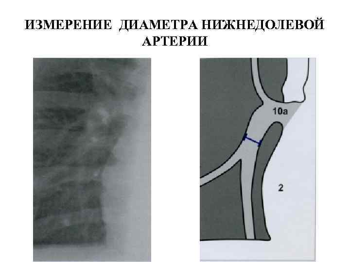 ИЗМЕРЕНИЕ ДИАМЕТРА НИЖНЕДОЛЕВОЙ    АРТЕРИИ 