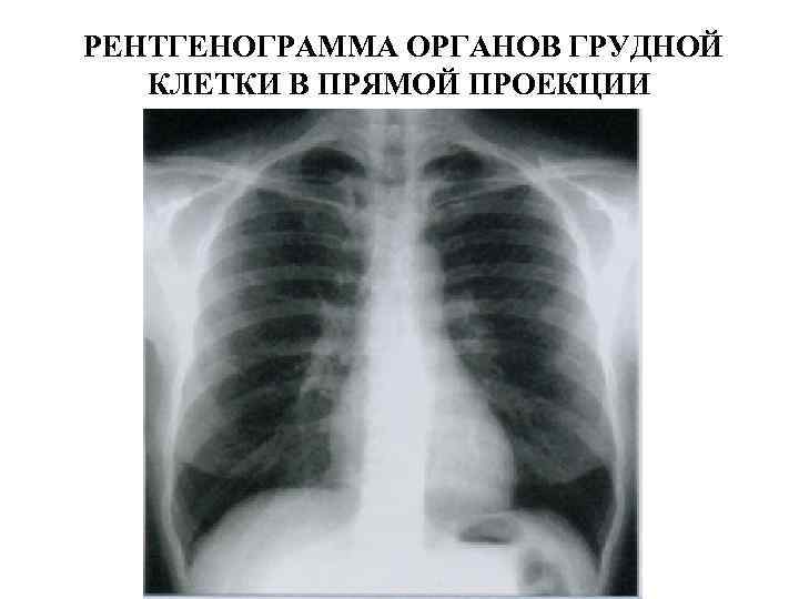  РЕНТГЕНОГРАММА ОРГАНОВ ГРУДНОЙ КЛЕТКИ В ПРЯМОЙ ПРОЕКЦИИ 