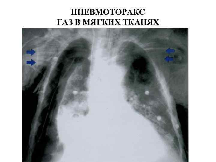   ПНЕВМОТОРАКС ГАЗ В МЯГКИХ ТКАНЯХ 