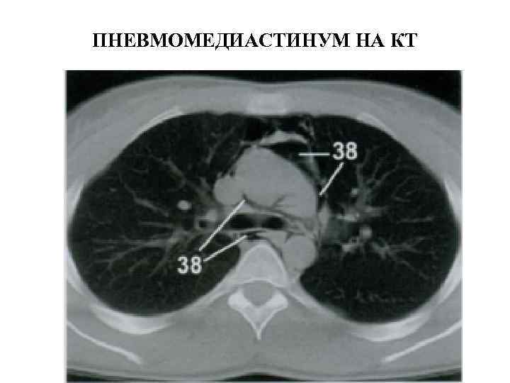 ПНЕВМОМЕДИАСТИНУМ НА КТ 