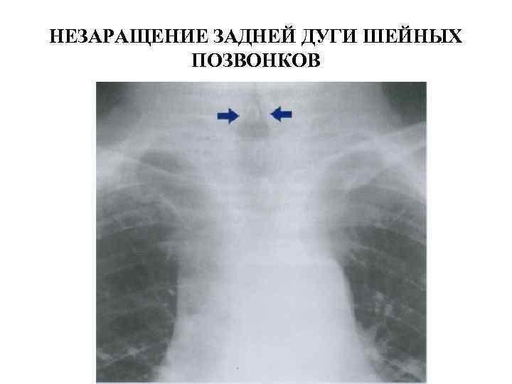 НЕЗАРАЩЕНИЕ ЗАДНЕЙ ДУГИ ШЕЙНЫХ  ПОЗВОНКОВ 