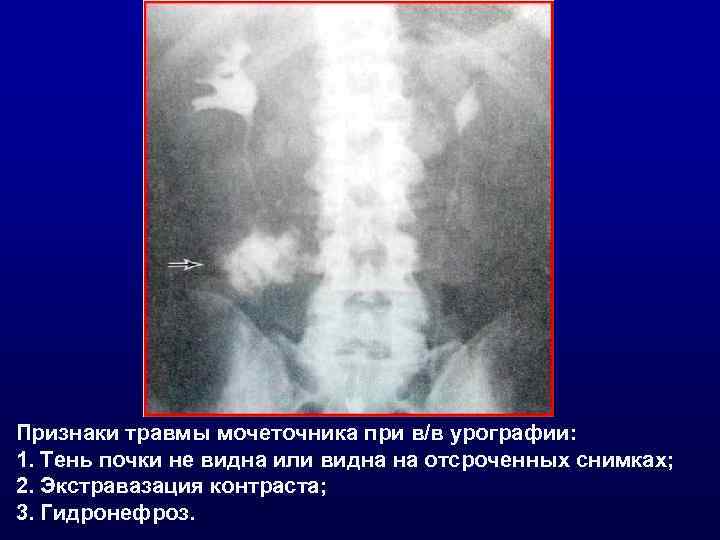 Признаки травмы мочеточника при в/в урографии: 1. Тень почки не видна или видна на