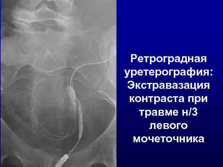  Ретроградная уретерография: Экстравазация контраста при  травме н/3 левого  мочеточника 