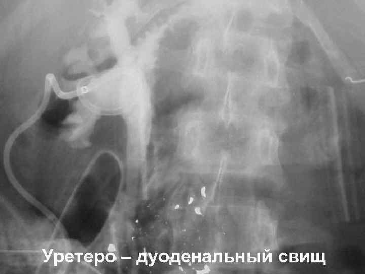 Уретеро – дуоденальный свищ 