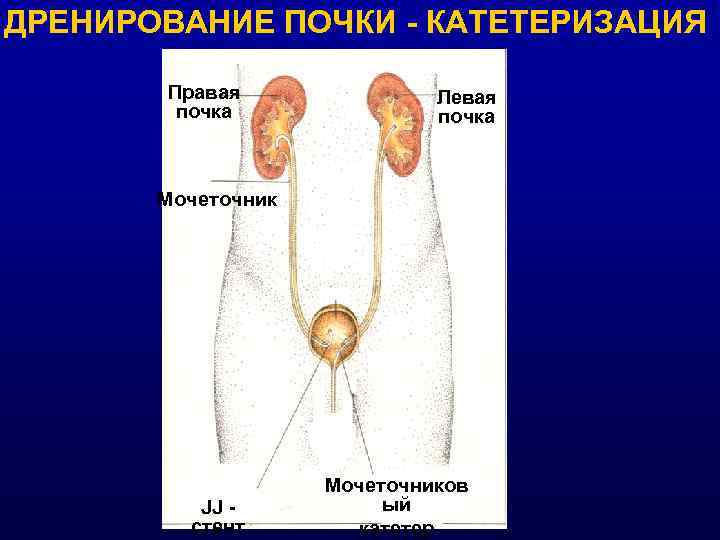 ДРЕНИРОВАНИЕ ПОЧКИ - КАТЕТЕРИЗАЦИЯ   Правая    Левая   почка
