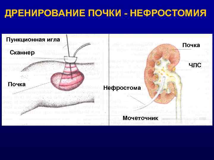 ДРЕНИРОВАНИЕ ПОЧКИ - НЕФРОСТОМИЯ Пункционная игла       Почка Сканнер
