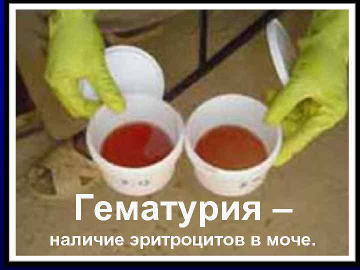  Гематурия – наличие эритроцитов в моче. 