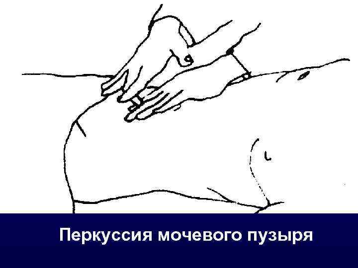 Перкуссия мочевого пузыря 