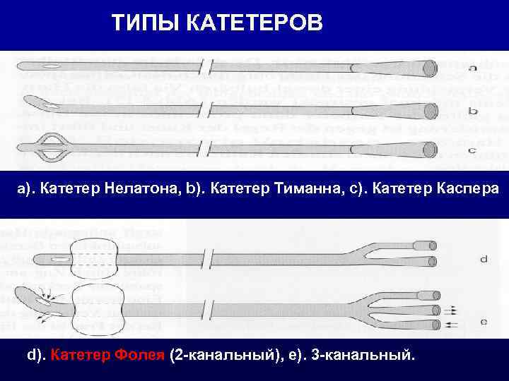   ТИПЫ КАТЕТЕРОВ a). Катетер Нелатона, b). Катетер Тиманна, c). Катетер Каспера d).