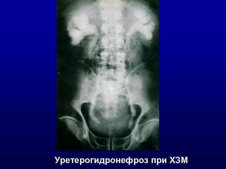 Уретерогидронефроз при ХЗМ 