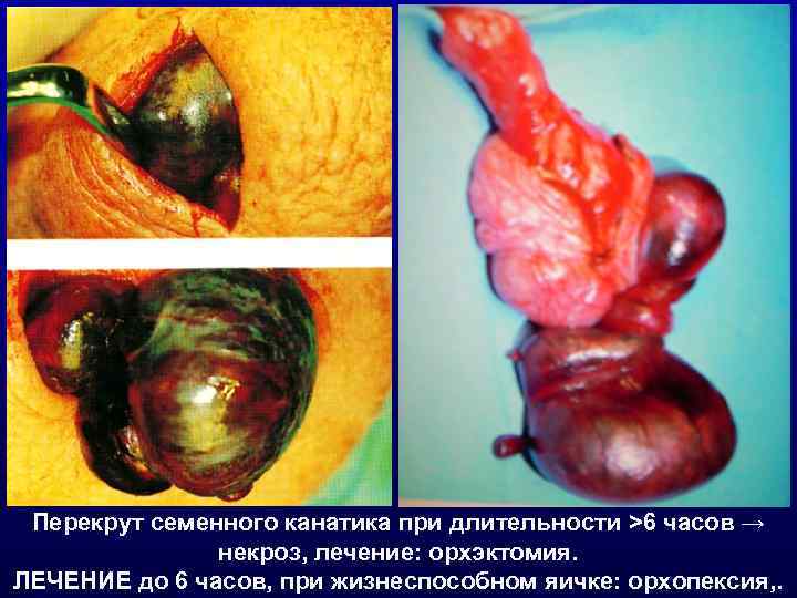  Перекрут семенного канатика при длительности >6 часов →    некроз, лечение: