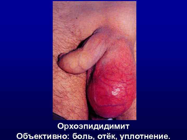   Орхоэпидидимит Объективно: боль, отёк, уплотнение. 