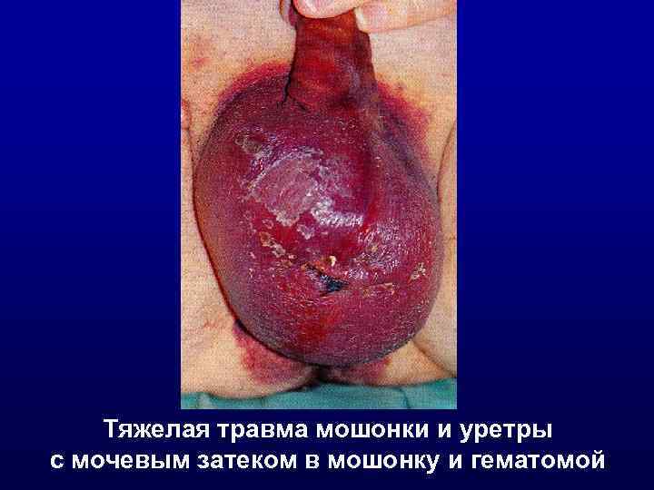   Тяжелая травма мошонки и уретры с мочевым затеком в мошонку и гематомой