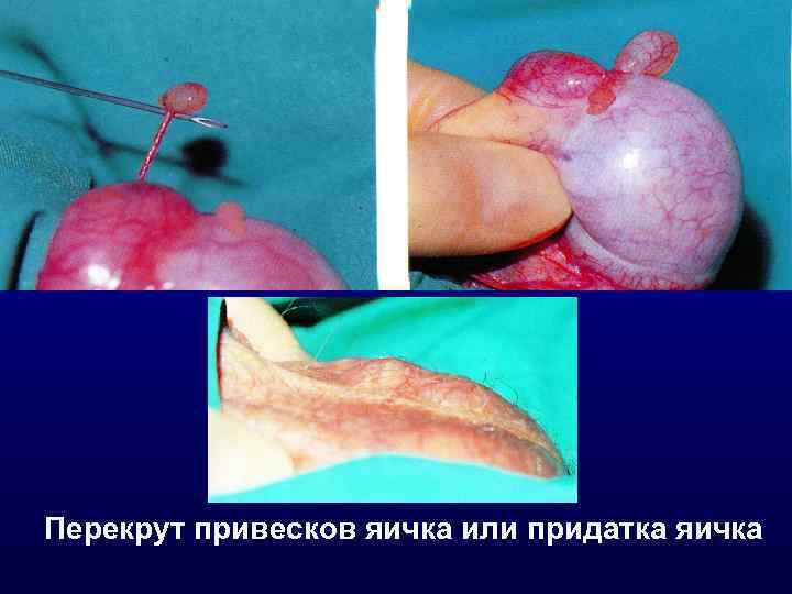 Перекрут привесков яичка или придатка яичка 