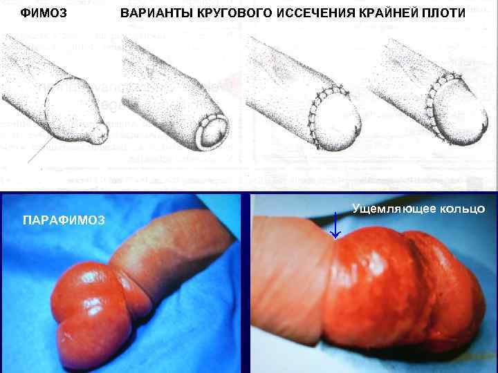 ФИМОЗ  ВАРИАНТЫ КРУГОВОГО ИССЕЧЕНИЯ КРАЙНЕЙ ПЛОТИ     Ущемляющее кольцо ПАРАФИМОЗ