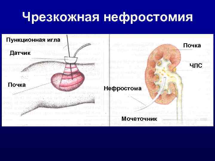   Чрезкожная нефростомия Пункционная игла       Почка Датчик