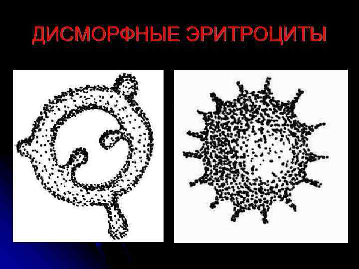 ДИСМОРФНЫЕ ЭРИТРОЦИТЫ 