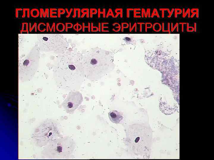 ГЛОМЕРУЛЯРНАЯ ГЕМАТУРИЯ ДИСМОРФНЫЕ ЭРИТРОЦИТЫ 