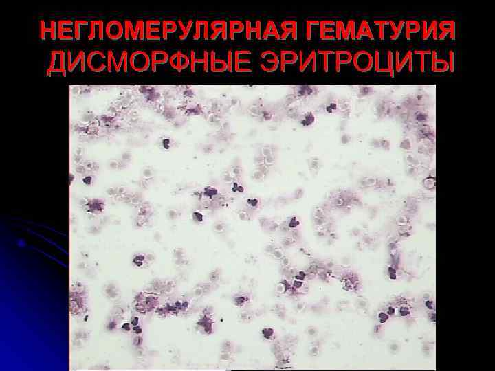 НЕГЛОМЕРУЛЯРНАЯ ГЕМАТУРИЯ ДИСМОРФНЫЕ ЭРИТРОЦИТЫ 