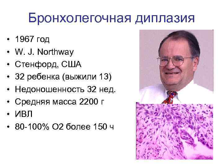 Бронхолегочная диплазия • • 1967 год W. J. Northway Стенфорд, США 32 ребенка (выжили